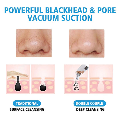 Ultimate Pore Cleanser & Blackhead Vacuum